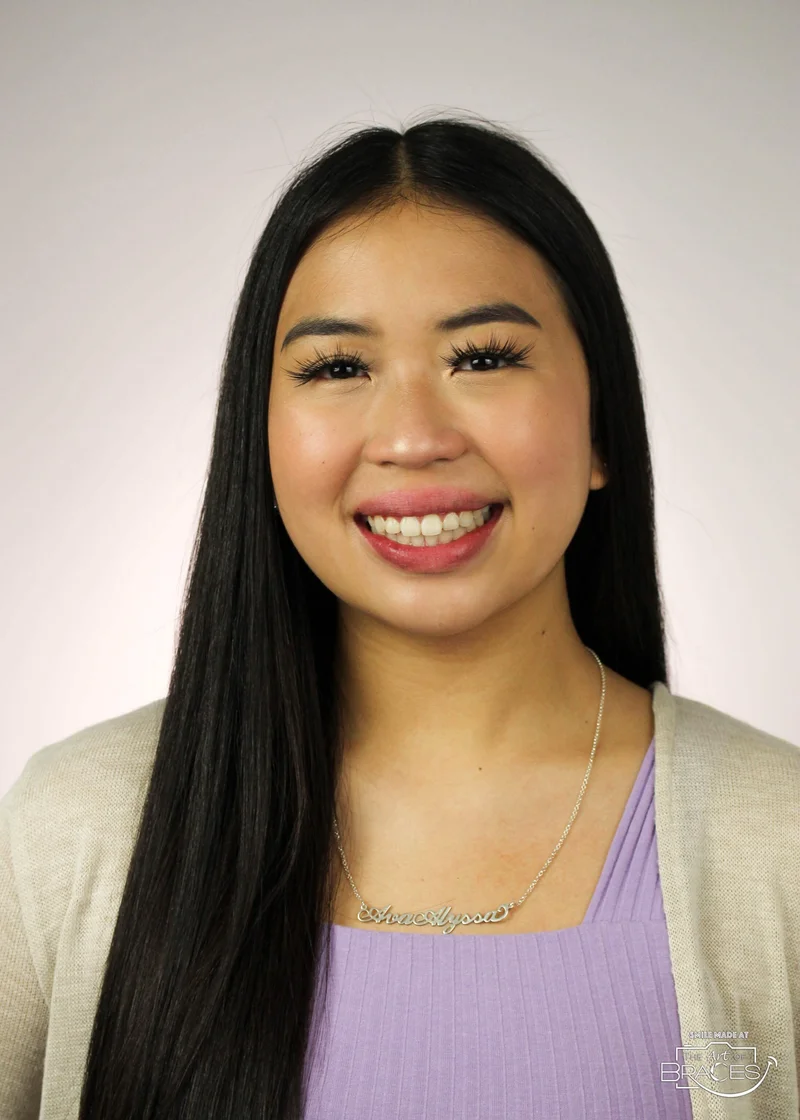 Facial Smiling - After Treatment