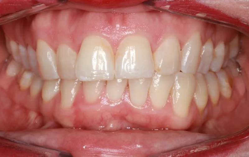 Center Bite - Before Treatment