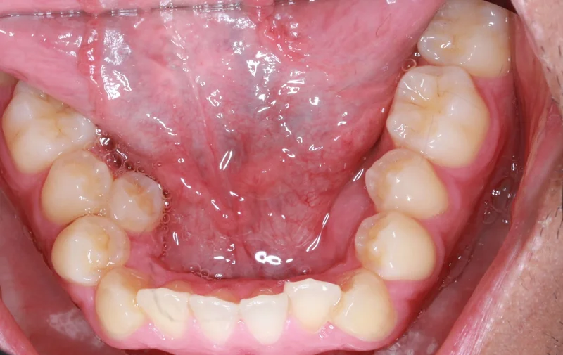 Lower Arch - Before Treatment