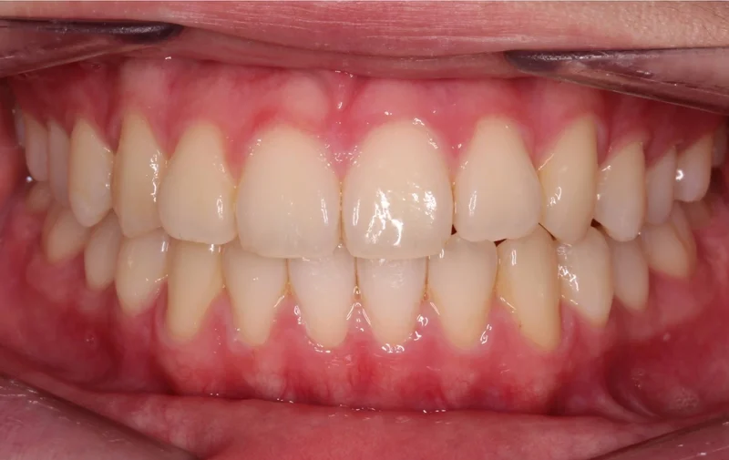 Center Bite - After Treatment