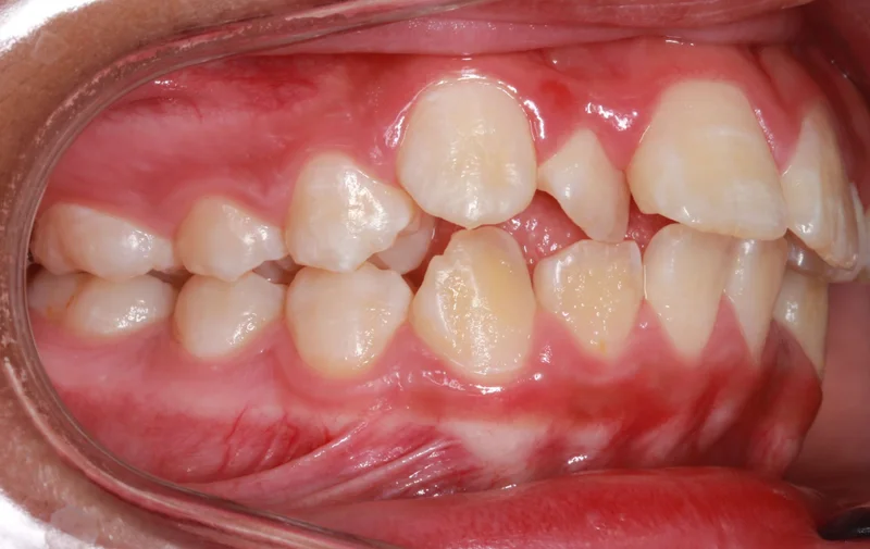 Right Side Bite - Before Treatment