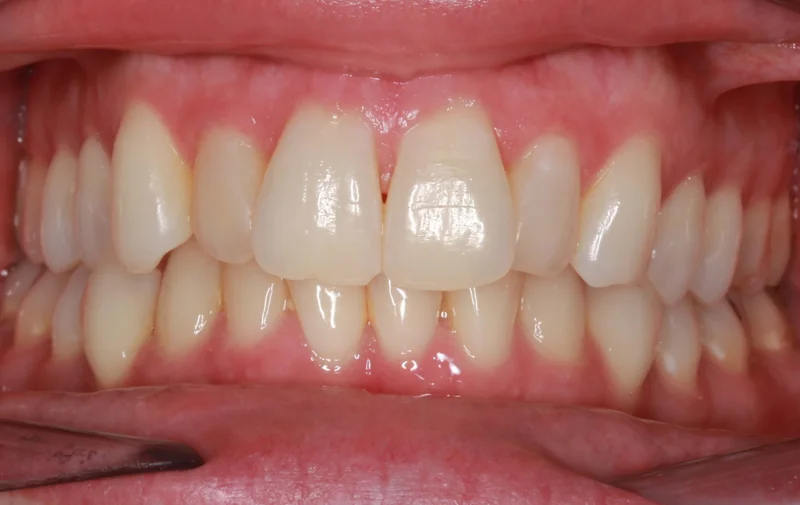 Center Bite - Before Treatment
