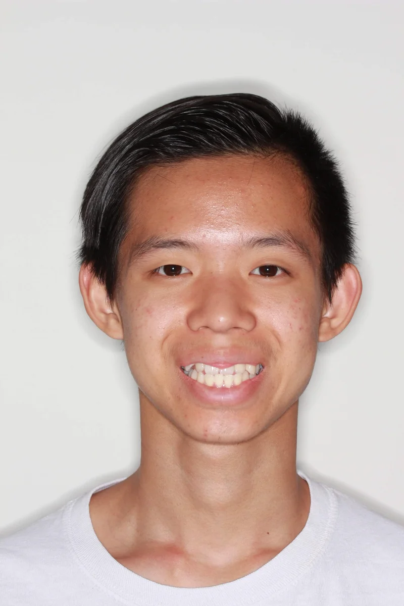 Facial Smiling - Before Treatment