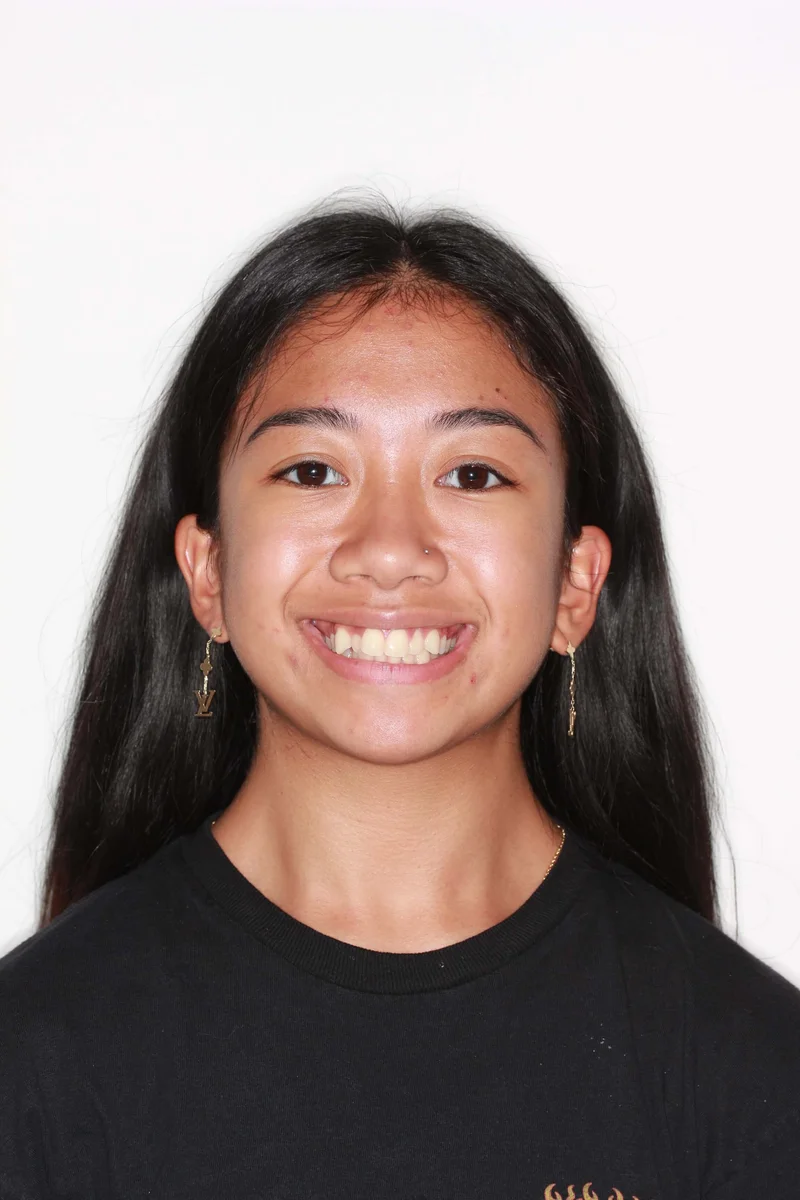 Facial Smiling - Before Treatment