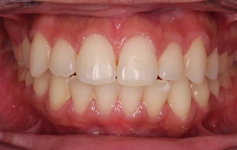 Center Smile - After Treatment
