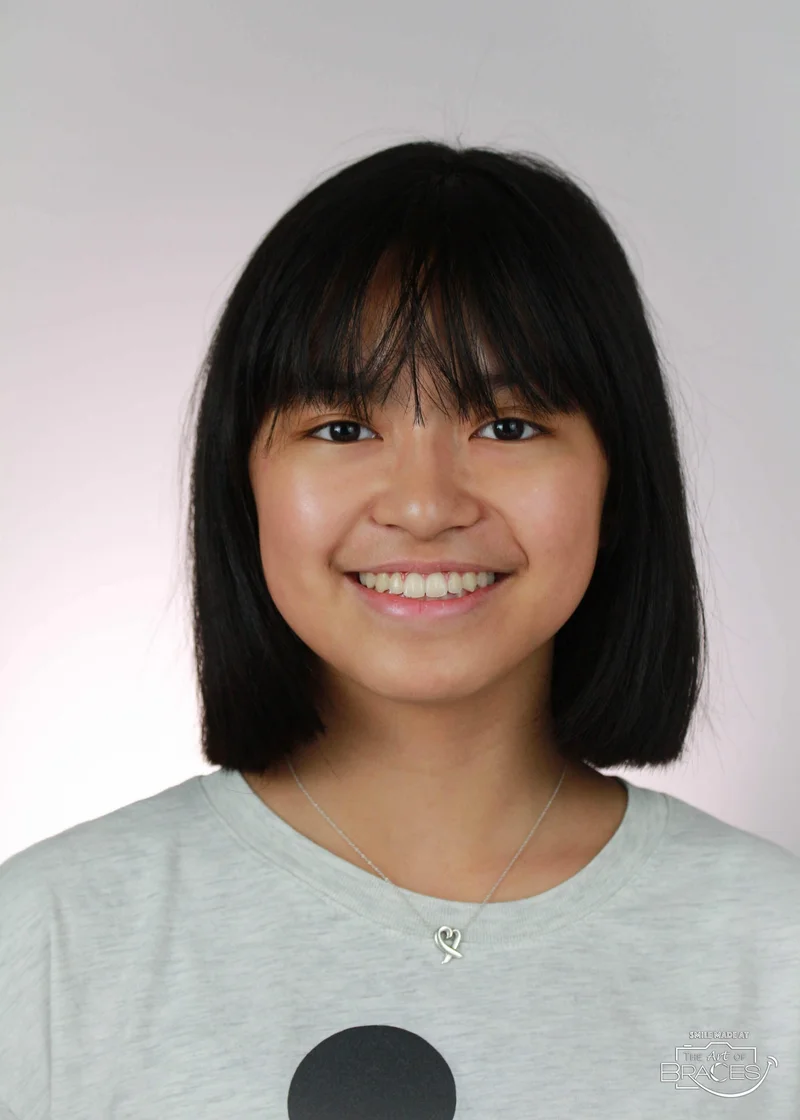 Facial Smiling - After Treatment