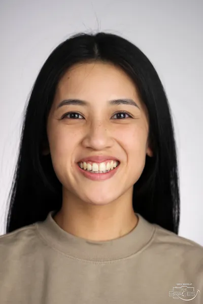After Metal Braces treatment - Case 72600