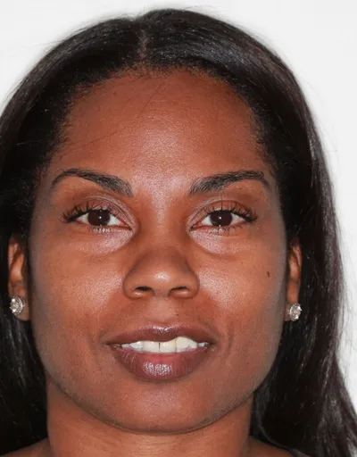 Before Metal Braces treatment - Case 72587
