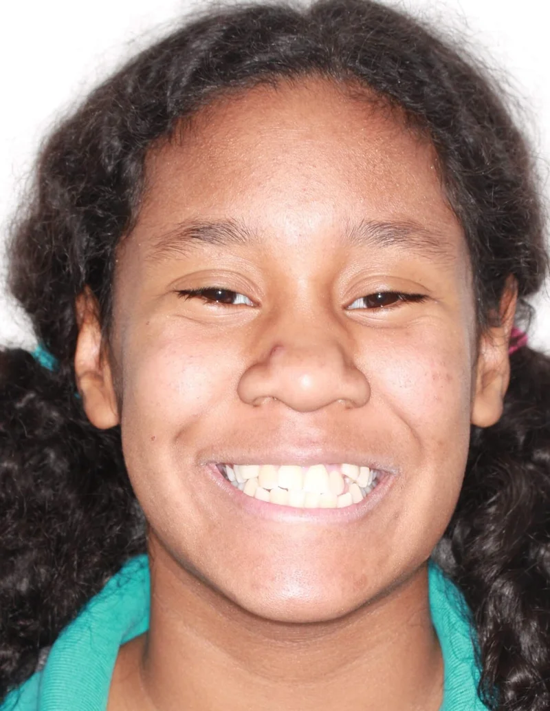 Facial Smiling - Before Treatment