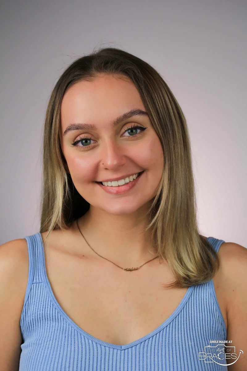 Facial Smiling - After Treatment