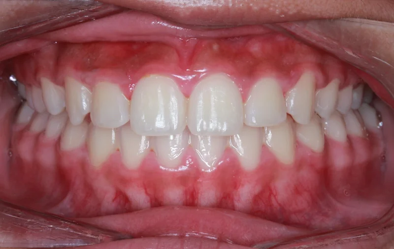 Center Bite - After Treatment