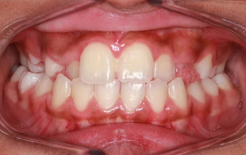 Center Bite - Before Treatment