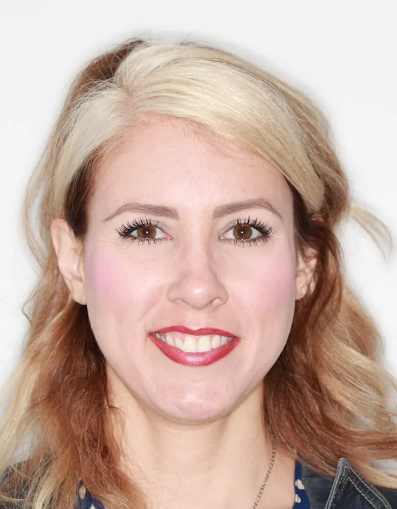 Facial Smiling - Before Treatment