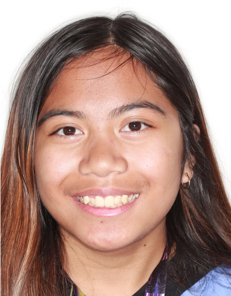 Facial Smiling - Before Treatment