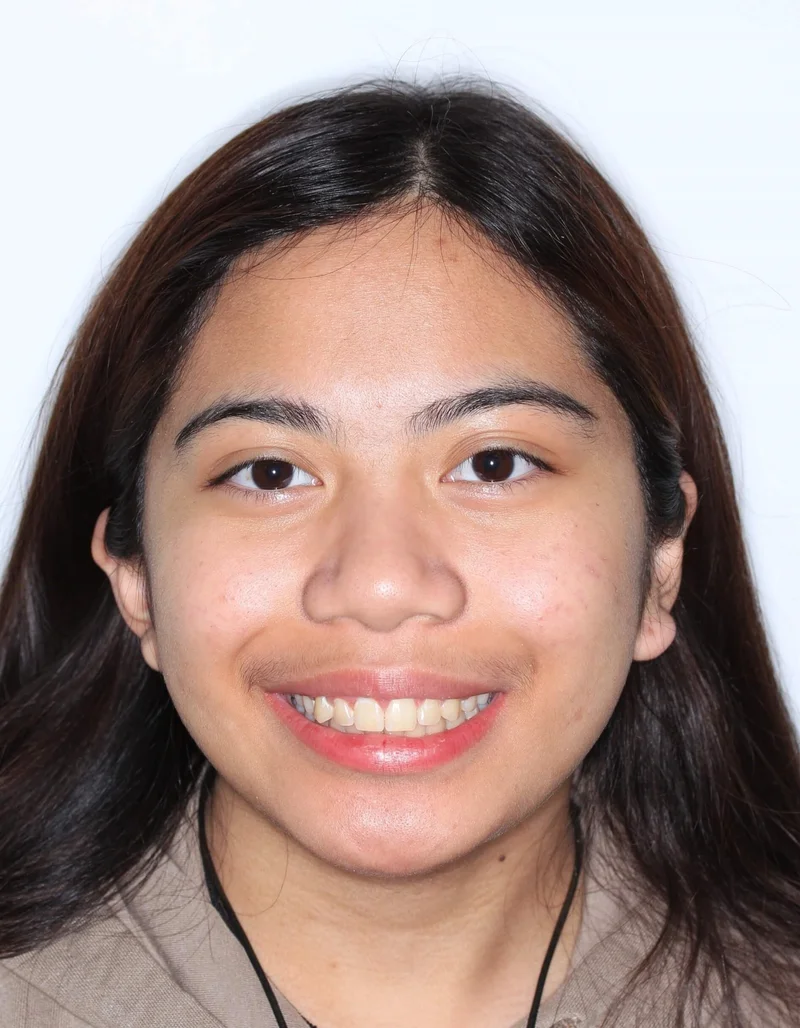 Facial Smiling - After Treatment