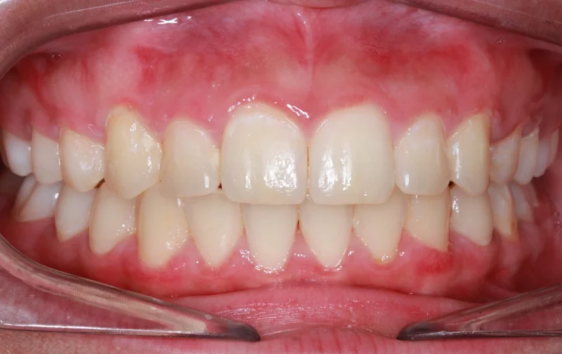 Center Bite - After Treatment