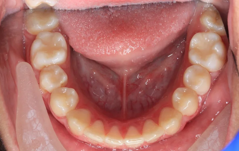 Lower Occlusal - After Treatment