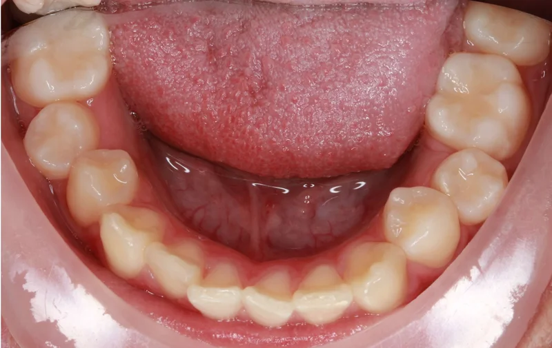 Lower Occlusal - Before Treatment