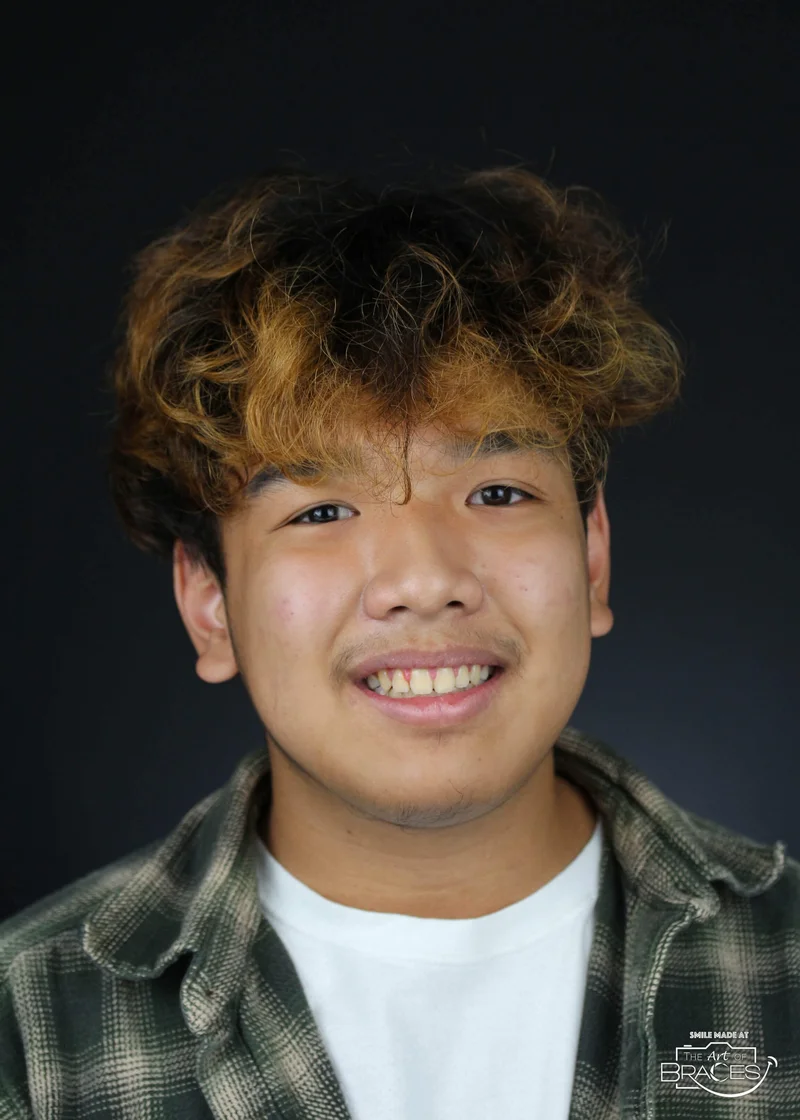 Facial Smiling - After Treatment