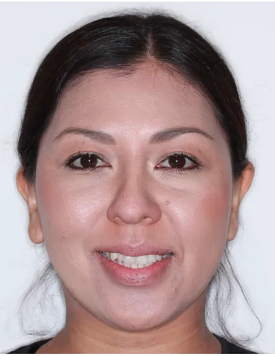 Before Clear Braces treatment - Case 78503