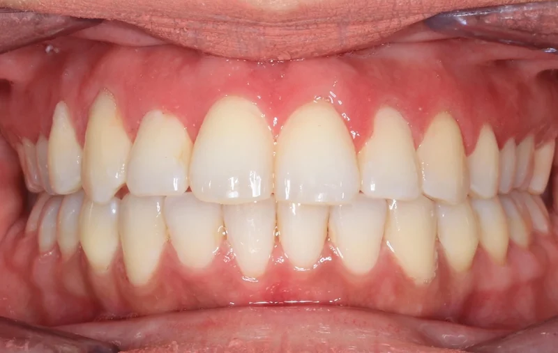 Center Bite - After Treatment