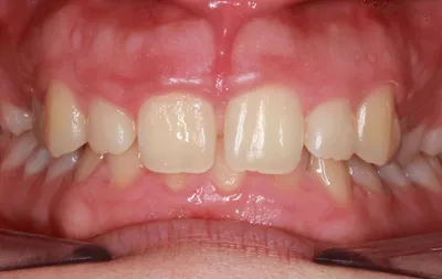 Before Metal Braces treatment - Case 78527