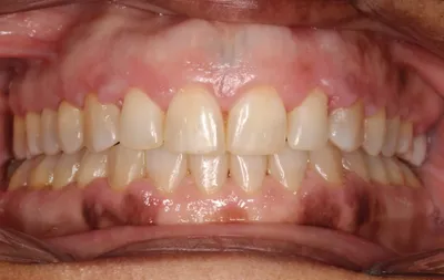 After Metal Braces treatment - Case 78528