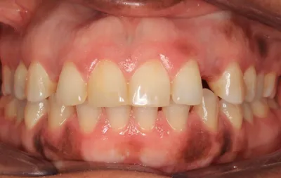 Before Metal Braces treatment - Case 78528