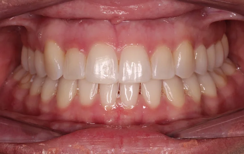 Center Bite - After Treatment