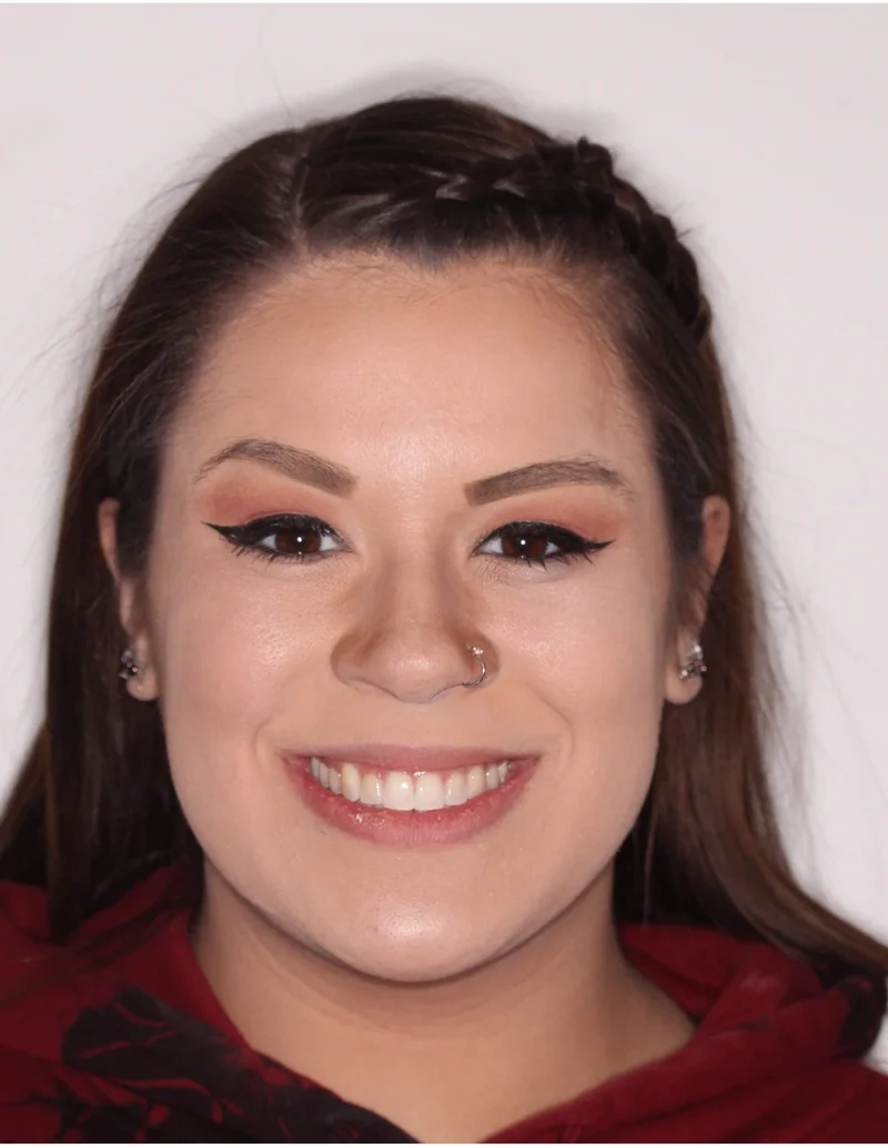 Facial Smiling - After Treatment