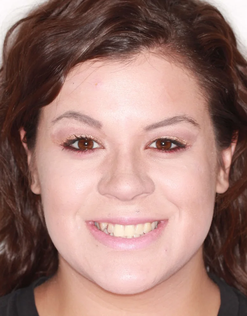 Facial Smiling - Before Treatment