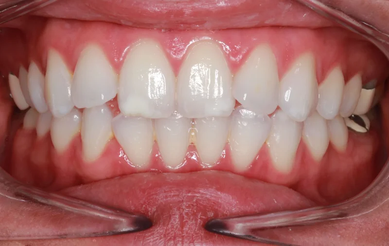 Center Bite - Before Treatment