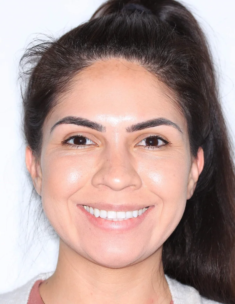 Facial Smiling - After Treatment