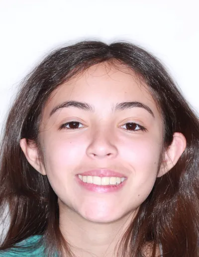After Metal Braces treatment - Case 79091
