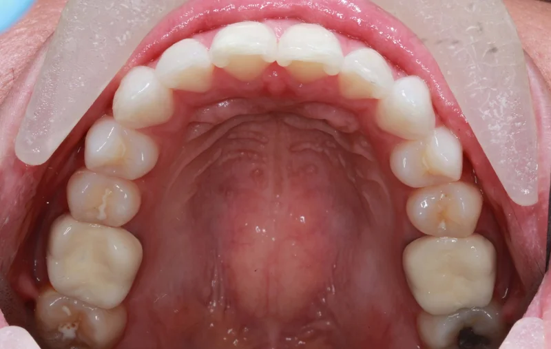 Upper Occlusal - After Treatment