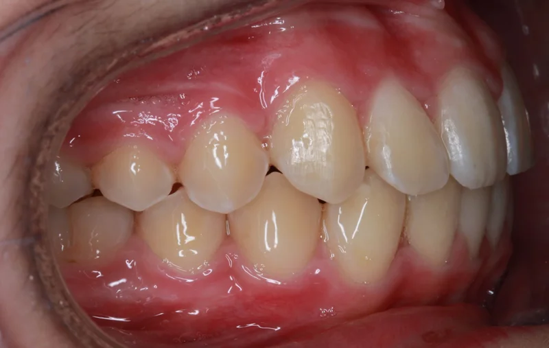 Right Buccal - After Treatment