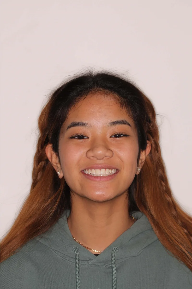 Facial Smiling - After Treatment