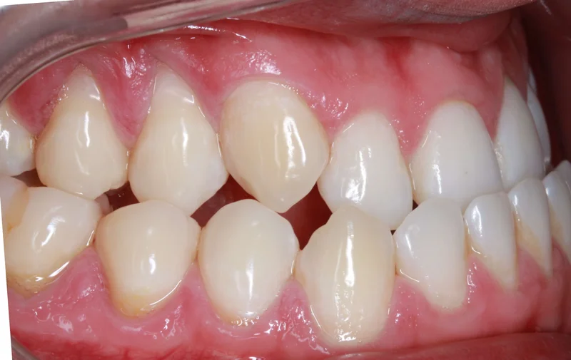 Right Buccal - Before Treatment