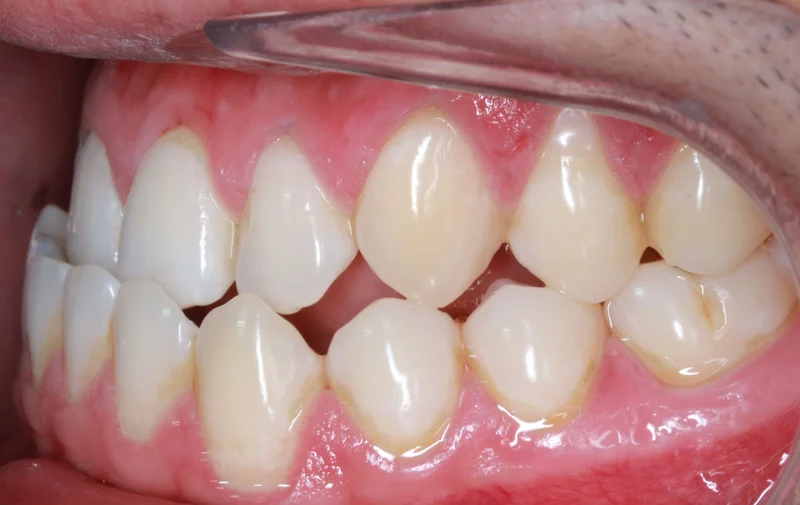 Left Buccal - Before Treatment