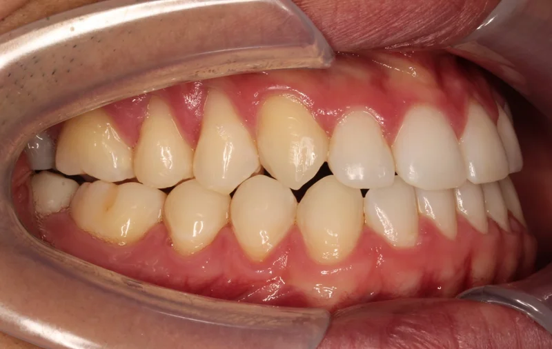 Right Buccal - After Treatment