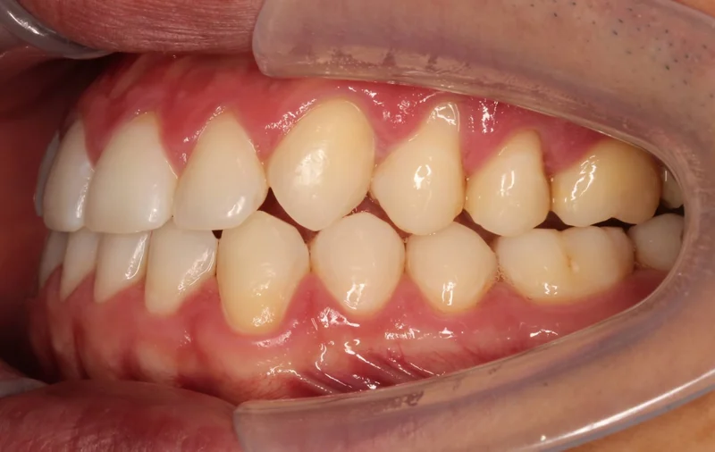 Left Buccal - After Treatment