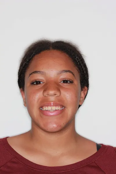 Before Metal Braces treatment - Case 84714
