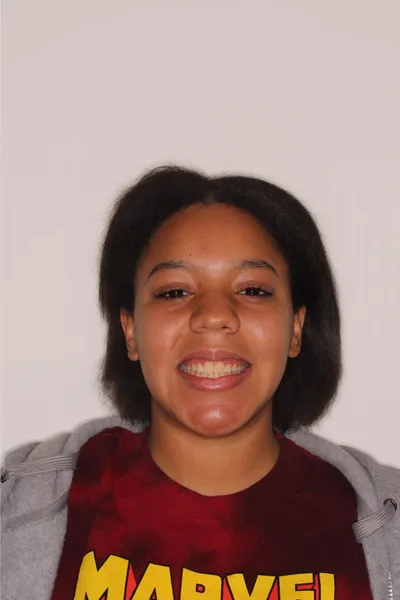 After Metal Braces treatment - Case 84714
