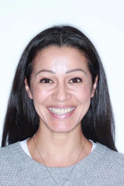 Before Clear Braces treatment - Case 84719