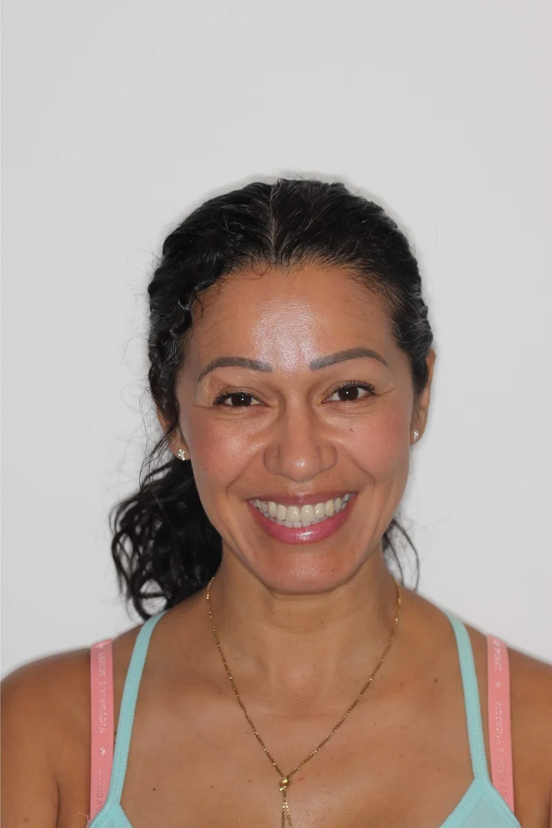 Facial Smiling - After Treatment