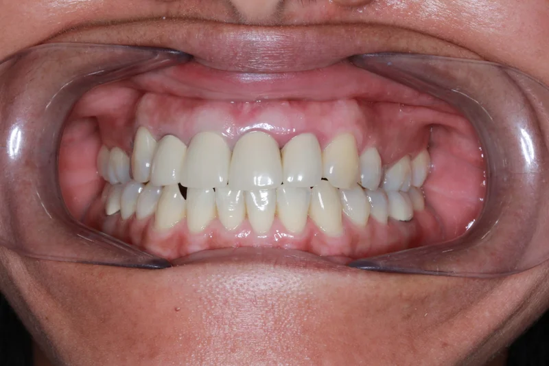 Center Bite - Before Treatment