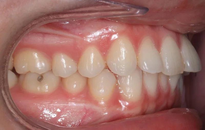 Right Buccal - Before Treatment