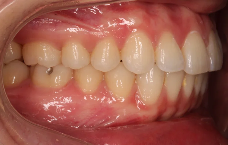 Right Buccal - After Treatment