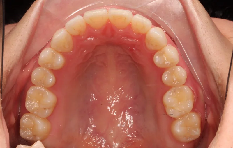 Upper Occlusal - After Treatment