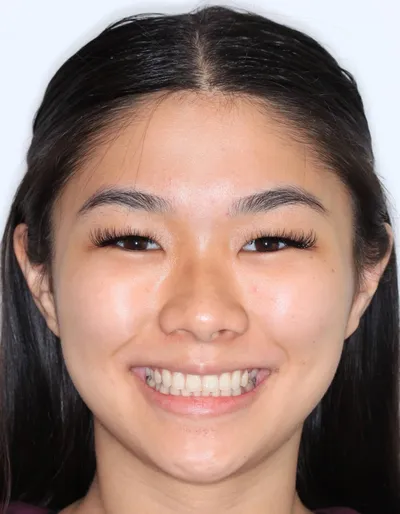 Before Metal Braces treatment - Case 84769